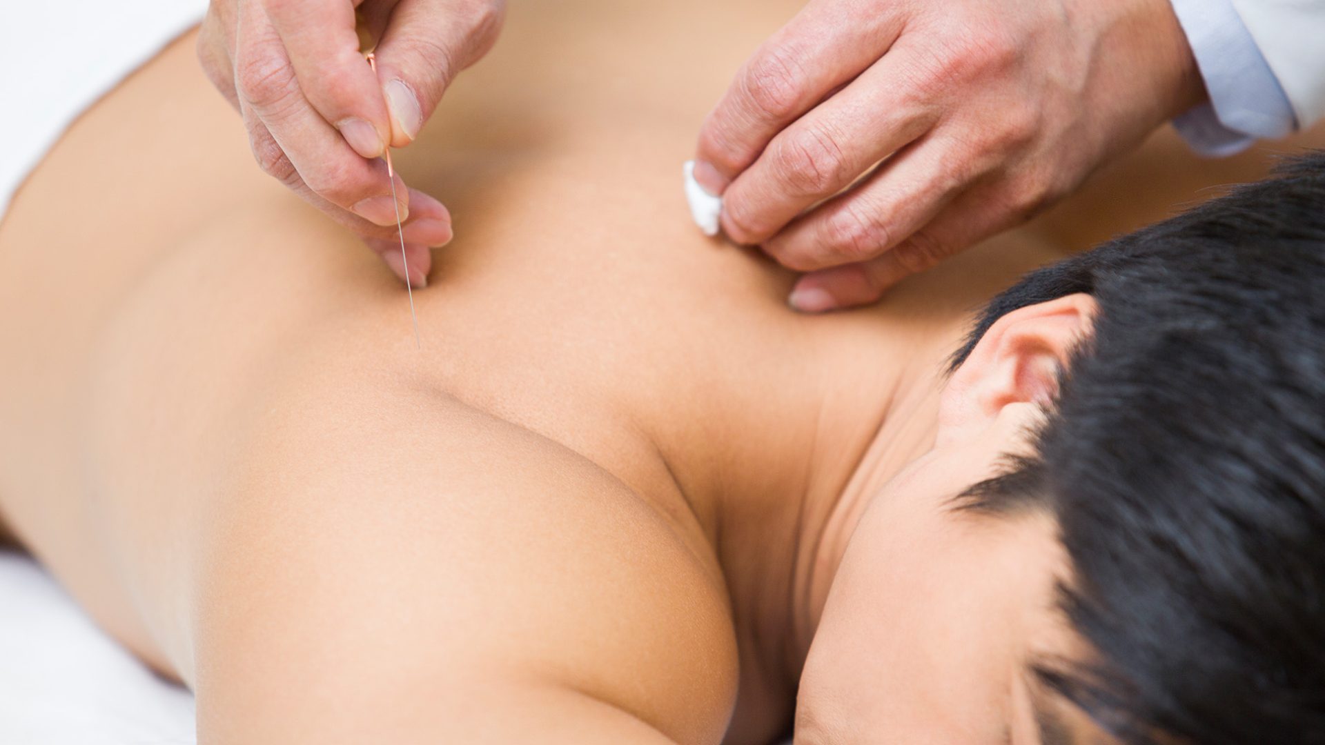 patient-receiving-acupuncture-2024-10-11-16-45-38-utc