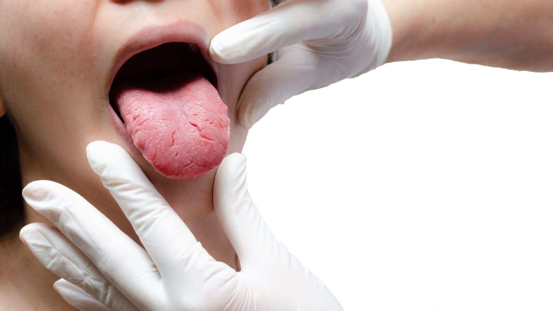 Tongue of a young Caucasian woman with benign migratory glossitis, held by a doctor wearing white gloves. Tongue with candidiasis. Cracks in the tongu